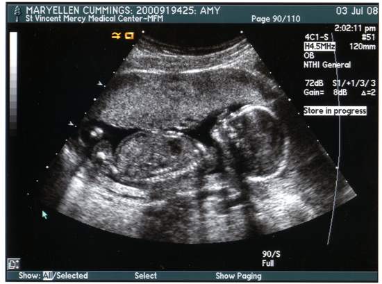 17 week ultrasound